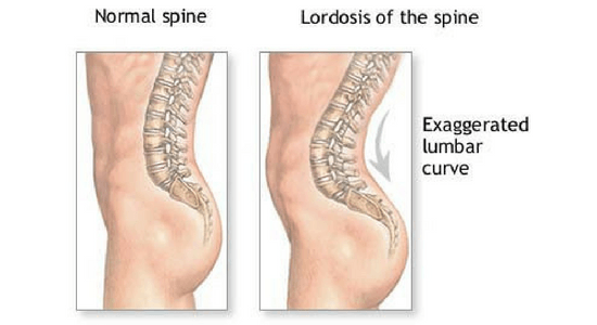 Fix anterior pelvic tilt 1