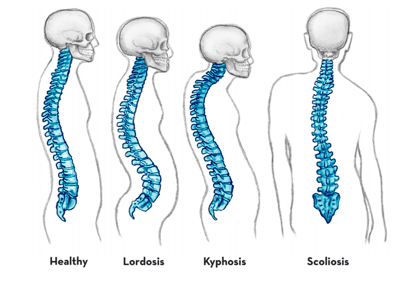 healthy-vs-unhealthy-spine