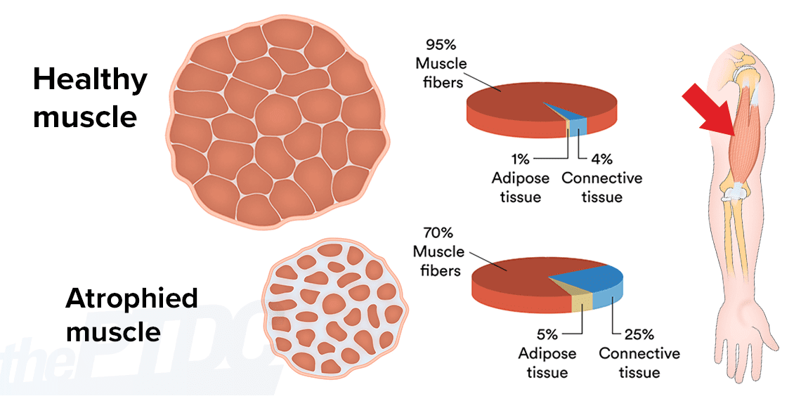 muscle-atrophy-after-injury