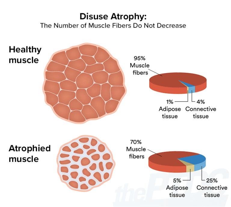 How to Fight Muscle Atrophy After Injury A Personal Trainer’s Guide